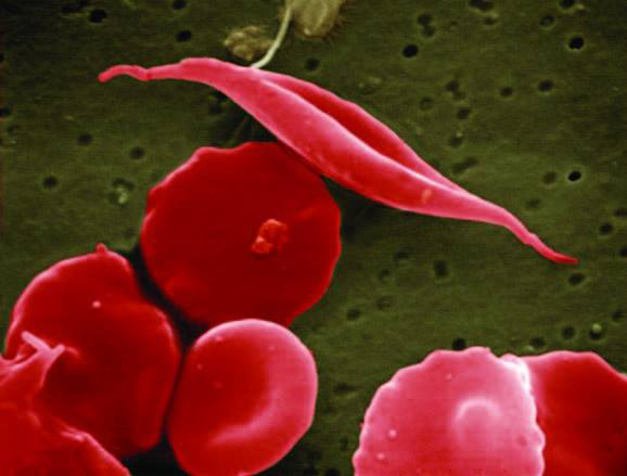 image of sickle cells